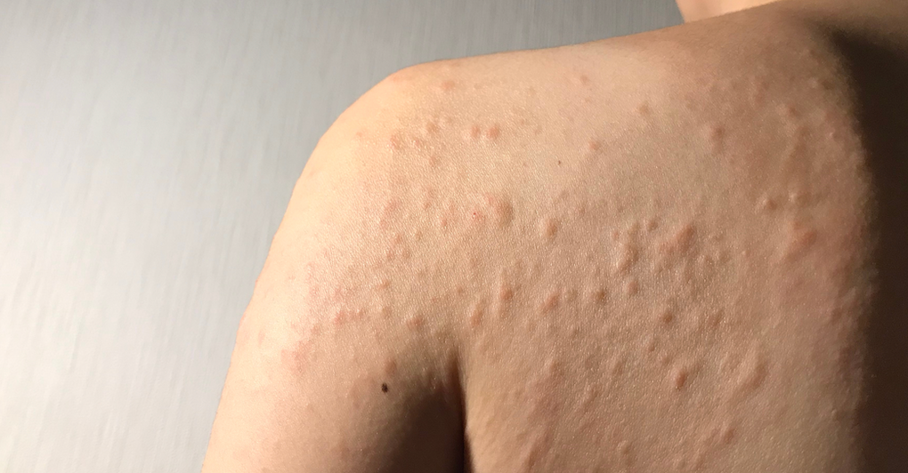 Allergy & Urticaria Treatment